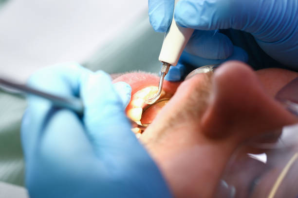 Best Emergency Dentist for Lost Fillings or Crowns in East Lansing, MI